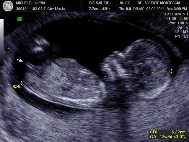 menino ou menina - ecografia 12 semanas